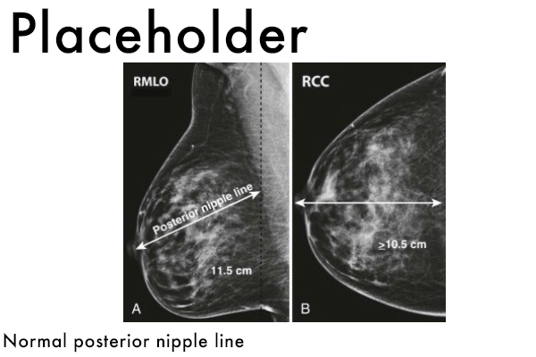 Mammography placeholder - Posterior Nipple Line